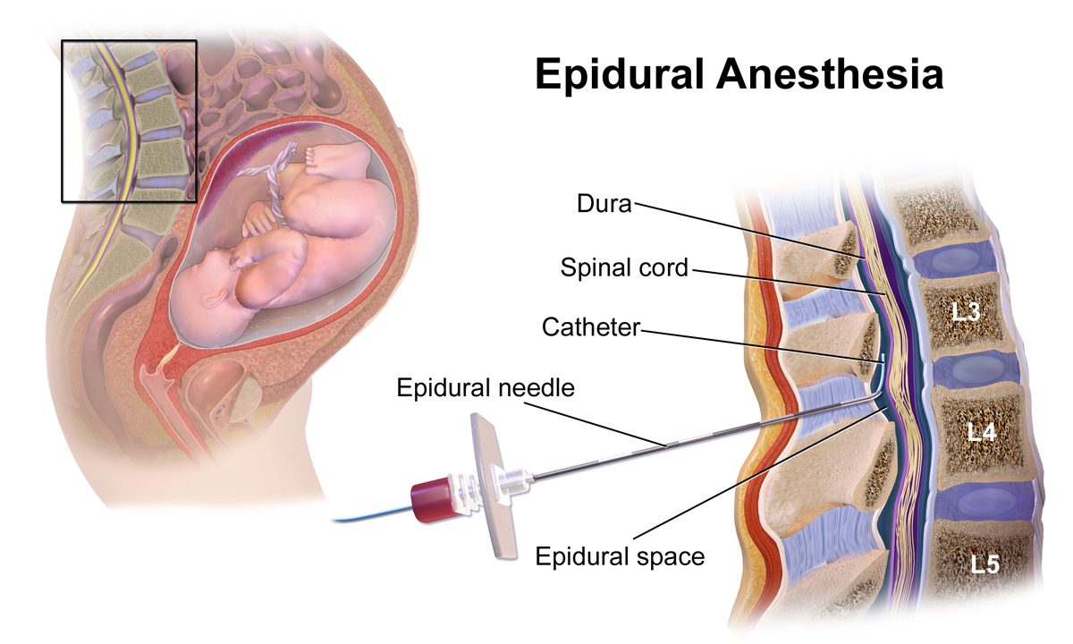 Epidural Risks: Mother & Baby featured image