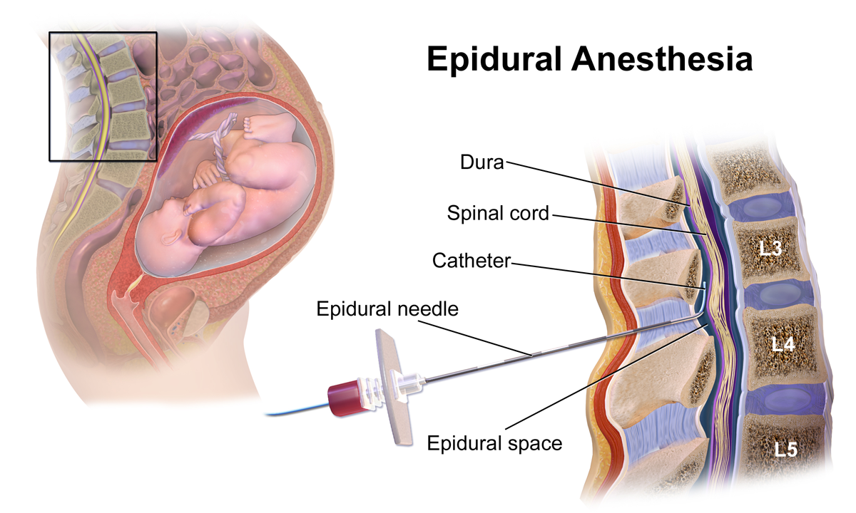 Epidural Risks: Mother & Baby