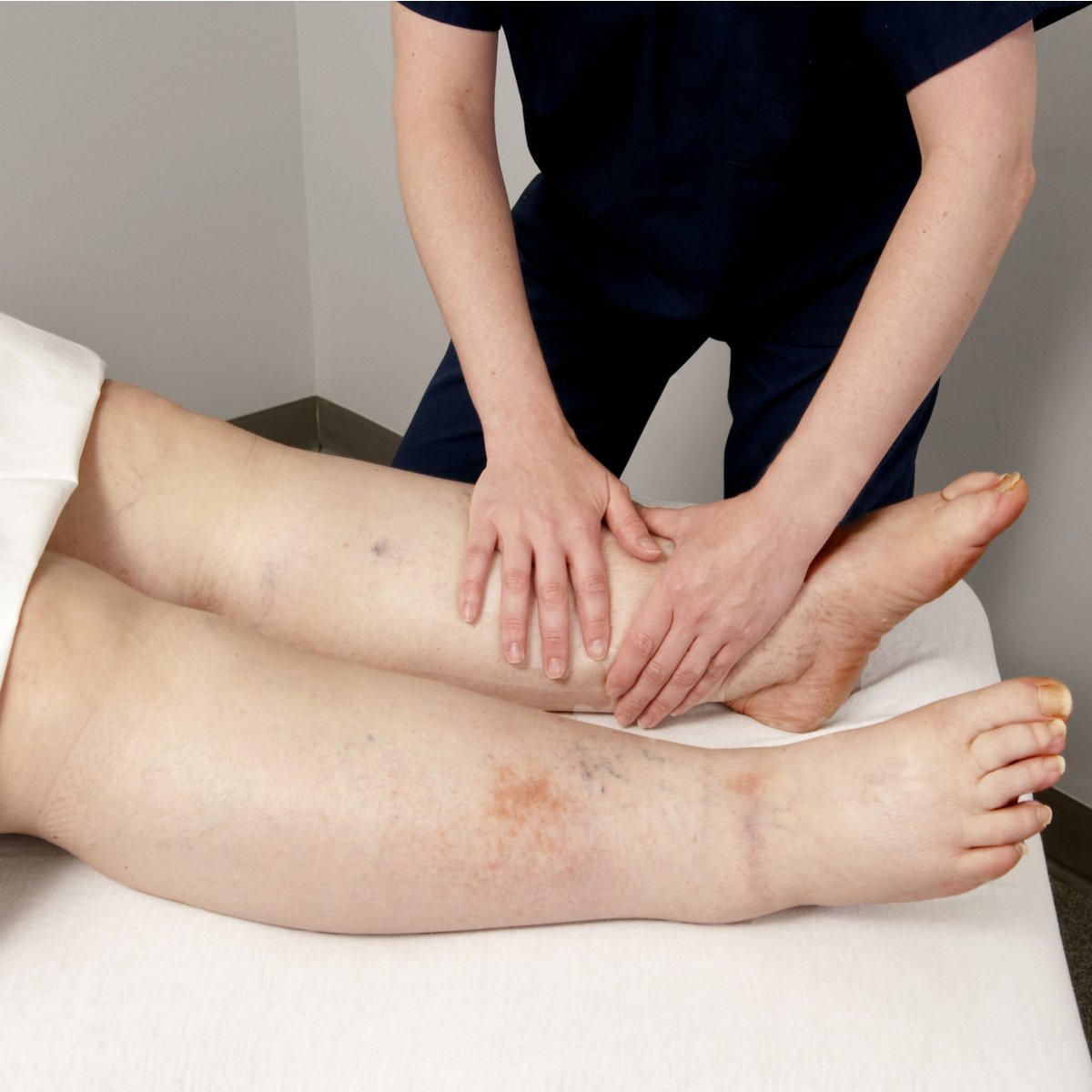 How Can Physical Therapy Help to Treat Lymphedema?